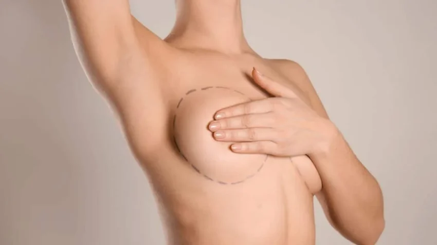 Mellfelvarrás implantátummal Debrecenben – Dr. Fábián Zsolt